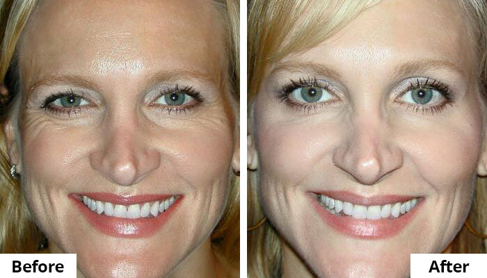 Before and After Comparison